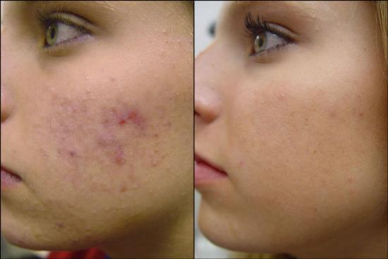Cystic Acne
